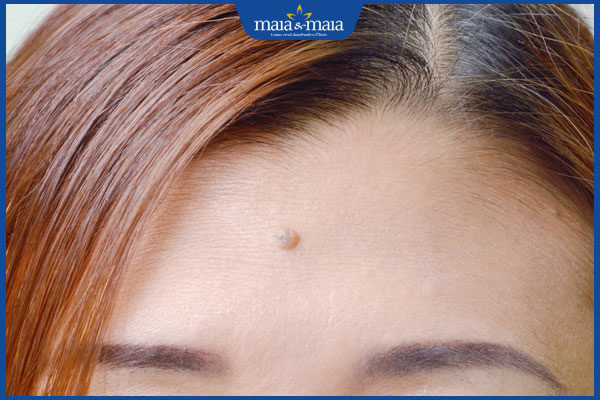 nốt ruồi trán nữ