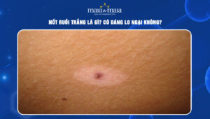 nốt ruồi trắng