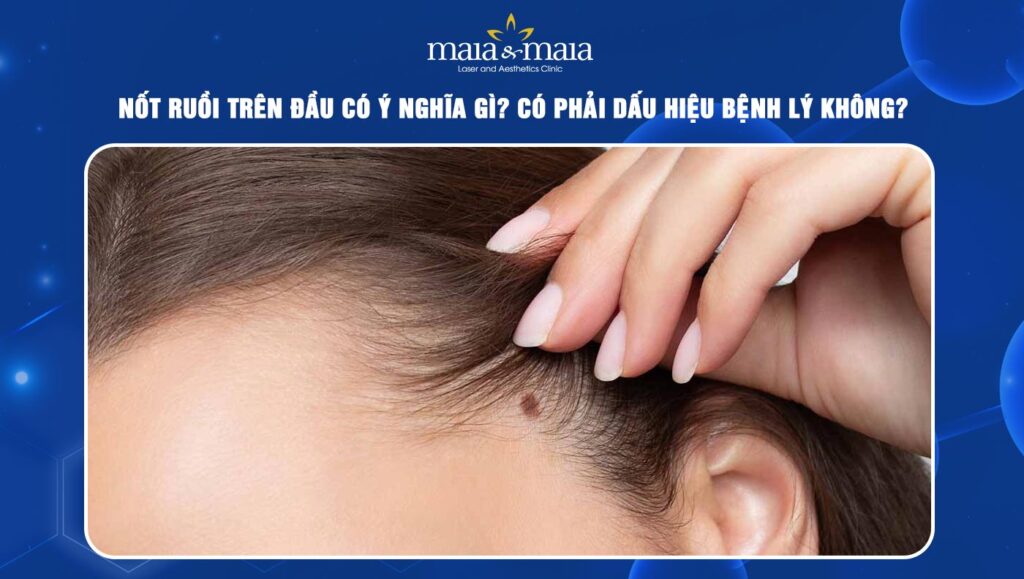 Nốt ruồi trên đầu