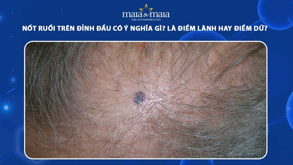 nốt ruồi trên đỉnh đầu