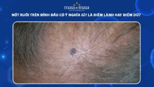 nốt ruồi trên đỉnh đầu