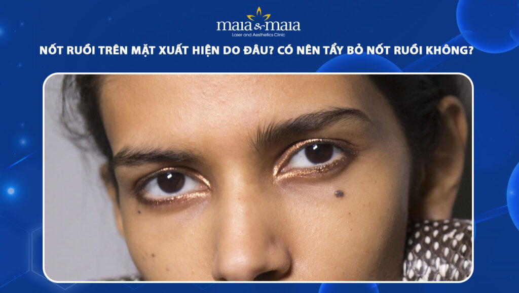 nốt ruồi trên mặt