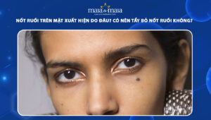 nốt ruồi trên mặt