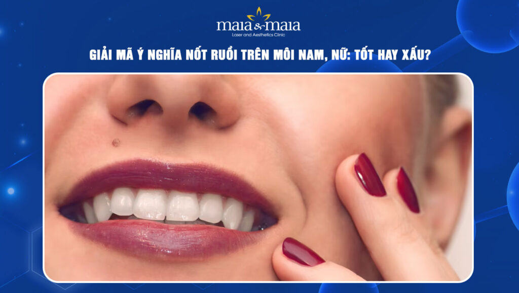 Giải mã ý nghĩa nốt ruồi trên môi nam, nữ. Tốt hay xấu? 1 nốt ruồi trên môi