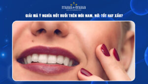 nốt ruồi trên môi