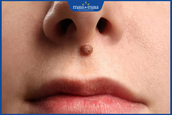 Tẩy nốt ruồi bằng laser CO2: Hiệu quả, quy trình và chi phí 3 nốt ruồi trên môi dưới mũi