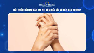 Nốt ruồi trên mu bàn tay