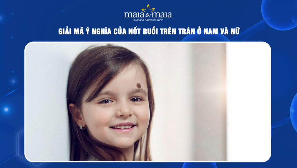 Nốt ruồi trên trán