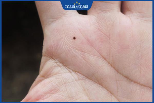 nốt ruồi trong bàn tay