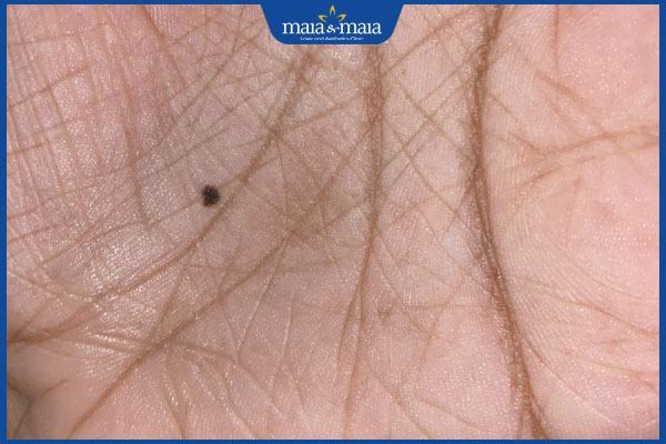 nốt ruồi trong lòng bàn tay