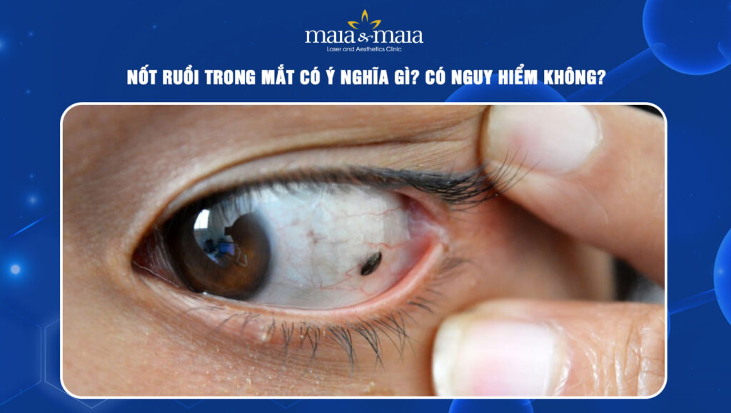 Nốt ruồi trong mắt có ý nghĩa gì? Có nguy hiểm không? 1 Nốt ruồi trong mắt