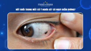 Nốt ruồi trong mắt