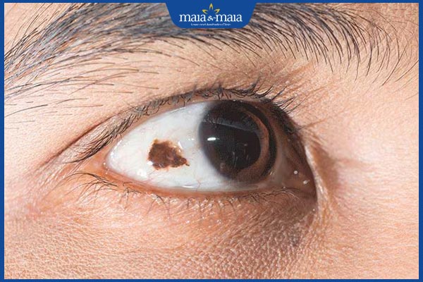 Nốt ruồi trong mắt có ý nghĩa gì? Có nguy hiểm không? 2 Nốt ruồi trong mắt phải nữ