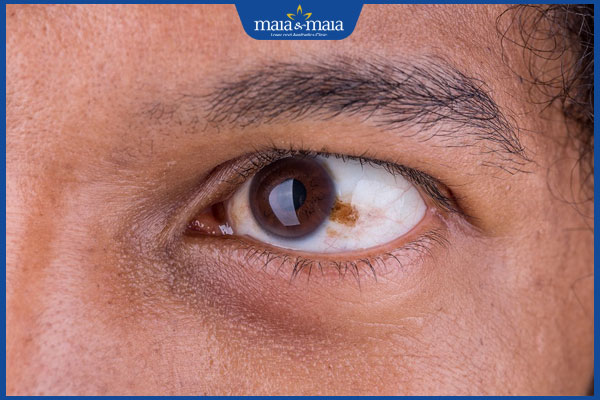 Nốt ruồi trong mắt có ý nghĩa gì? Có nguy hiểm không? 3 Nốt ruồi trong mắt trái nam