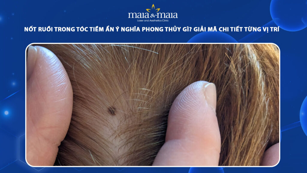 nốt ruồi trong tóc