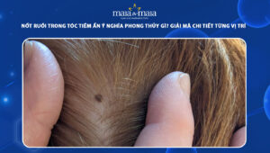 nốt ruồi trong tóc