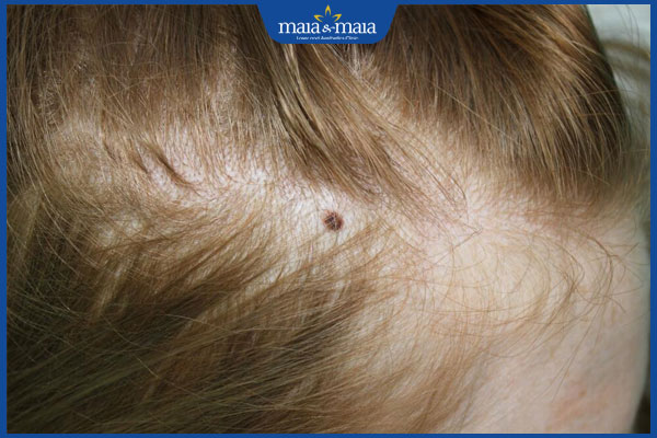 nốt ruồi trong tóc bên phải