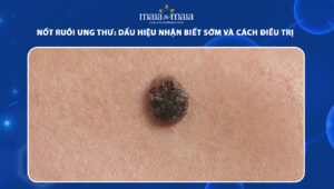 nốt ruồi ung thư