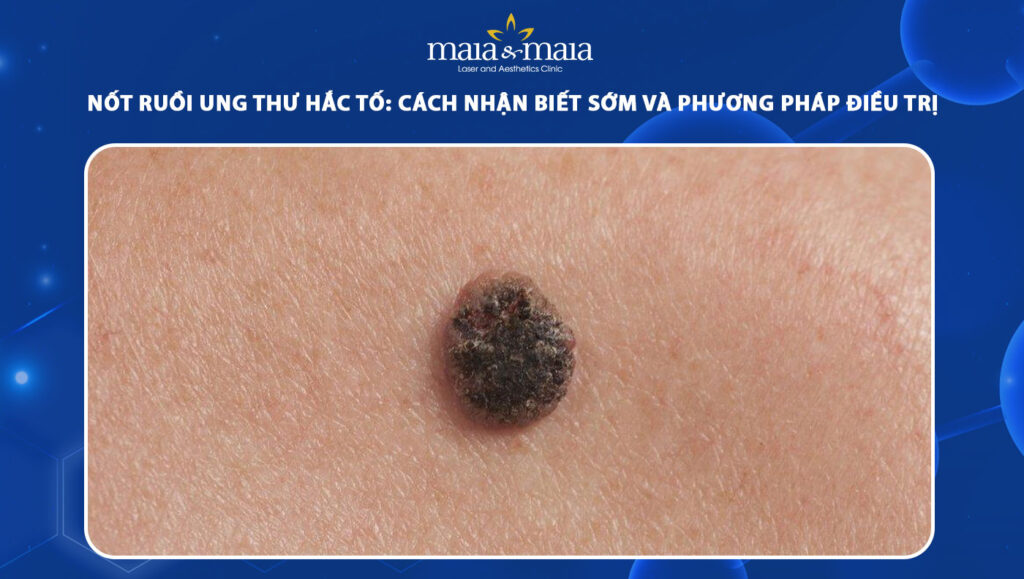 nốt ruồi ung thư hắc tố