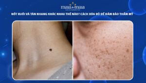 nốt ruồi và tàn nhang