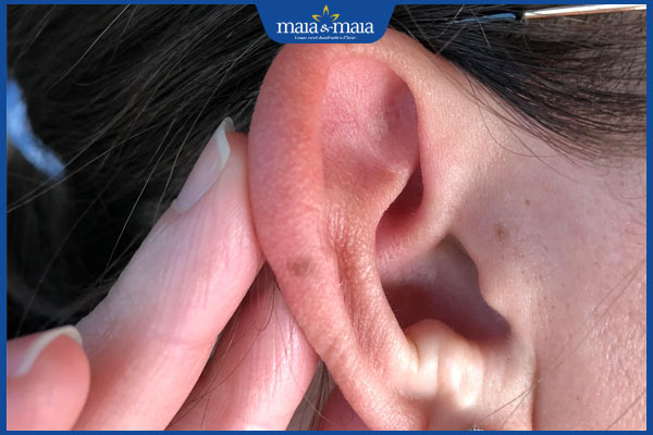 Luận giải ý nghĩa 6 vị trí nốt ruồi ở tai cho nam và nữ giới 4 nốt ruồi vành tai