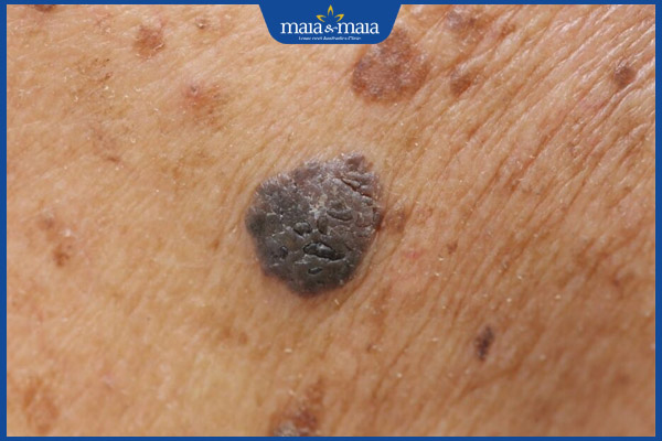 nốt ruồi vùng kín nam