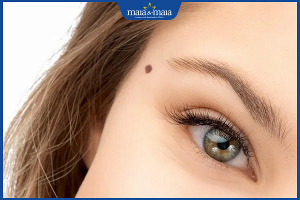 nốt ruồi vùng thái dương