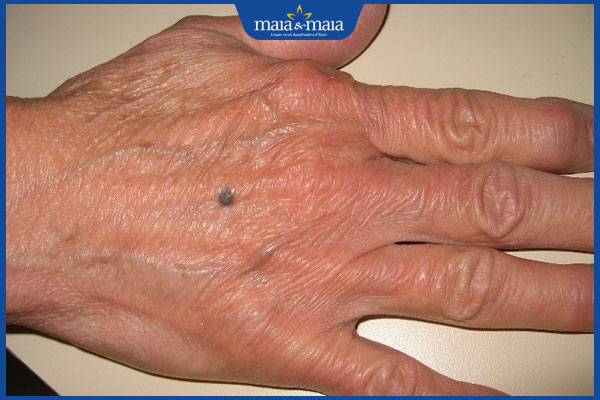 nốt ruồi xanh ở tay