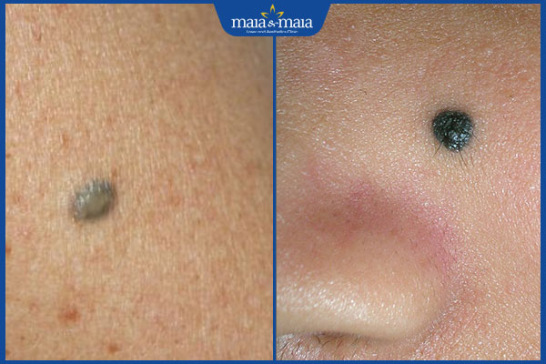 nốt ruồi xanh và đen