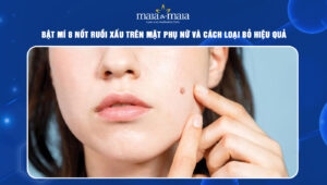 nốt ruồi xấu trên mặt phụ nữ