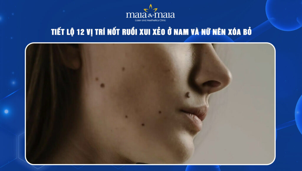 nốt ruồi xui xẻo