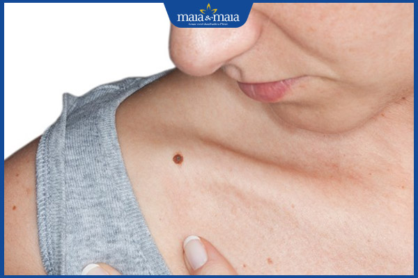 nốt ruồi xương quai xanh nữ