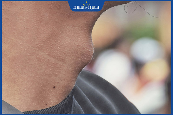 nốt ruồi yết hầu nam