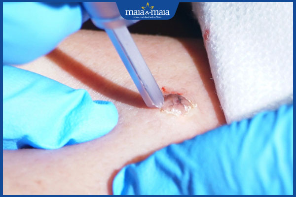 Nốt ruồi không điển hình nguy hiểm không? Dấu hiệu nhận biết 4 sinh thiết nốt ruồi