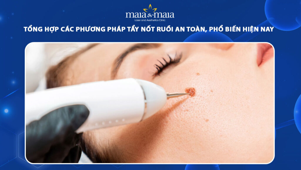 tẩy nốt ruồi
