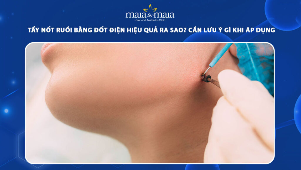 Tẩy nốt ruồi bằng đốt điện hiệu quả ra sao? Cần lưu ý gì? 1 tẩy nốt ruồi bằng đốt điện