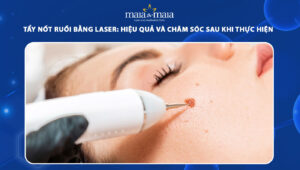 tẩy nốt ruồi bằng laser