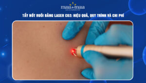 Tẩy nốt ruồi bằng laser CO2