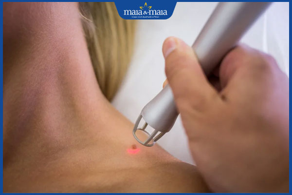 tẩy nốt ruồi bằng tia laser