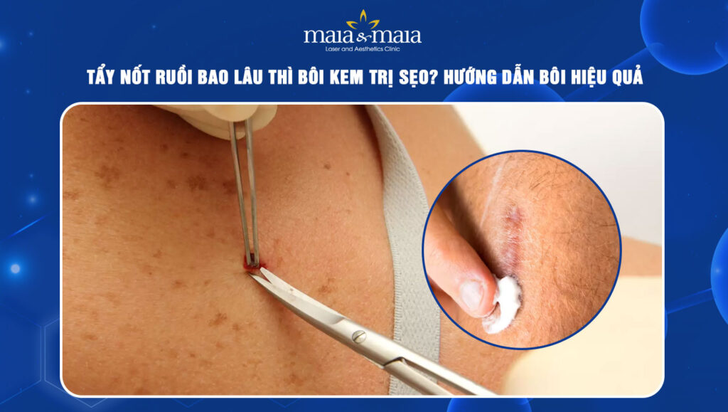tẩy nốt ruồi bao lâu thì bôi kem trị sẹo