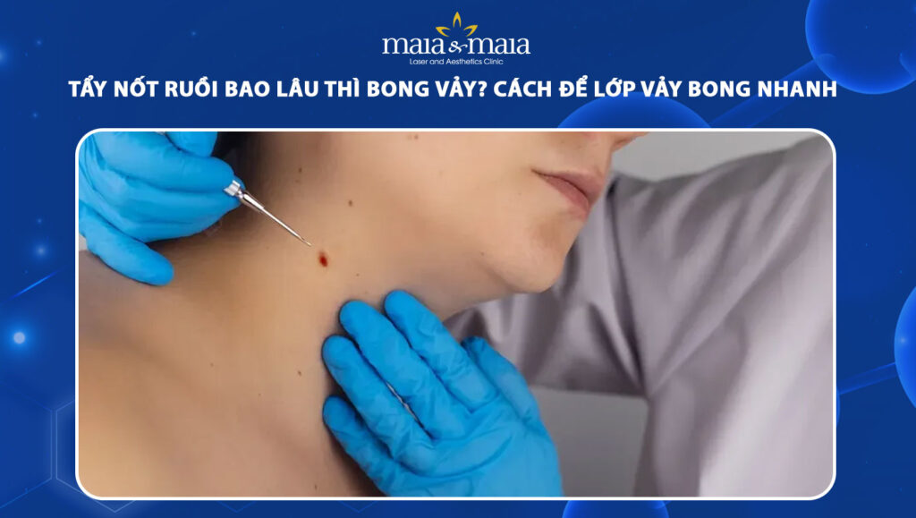 Tẩy nốt ruồi bao lâu thì bong vảy? Cách để vảy bong nhanh 1 tẩy nốt ruồi bao lâu thì bong vảy