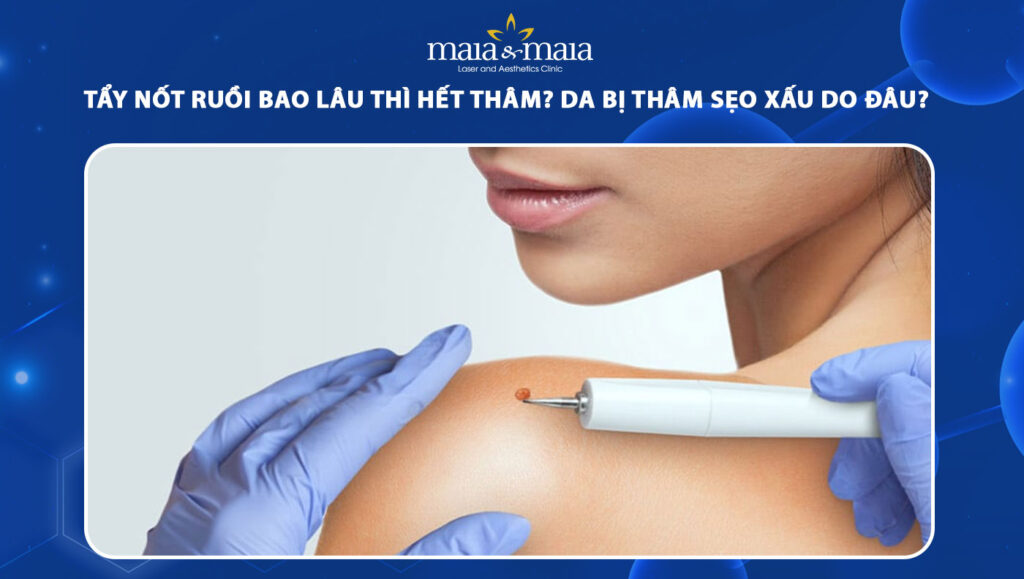 tẩy nốt ruồi bao lâu thì hết thâm
