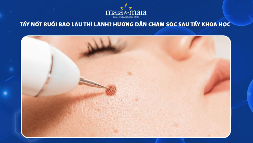 tẩy nốt ruồi bao lâu thì lành