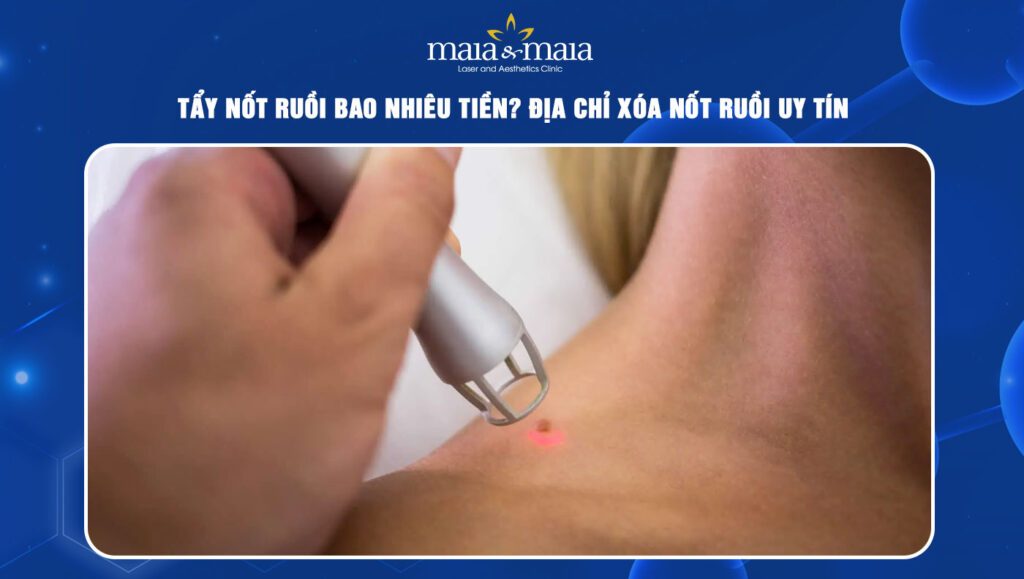 tẩy nốt ruồi bao nhiêu tiền