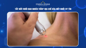 tẩy nốt ruồi bao nhiêu tiền