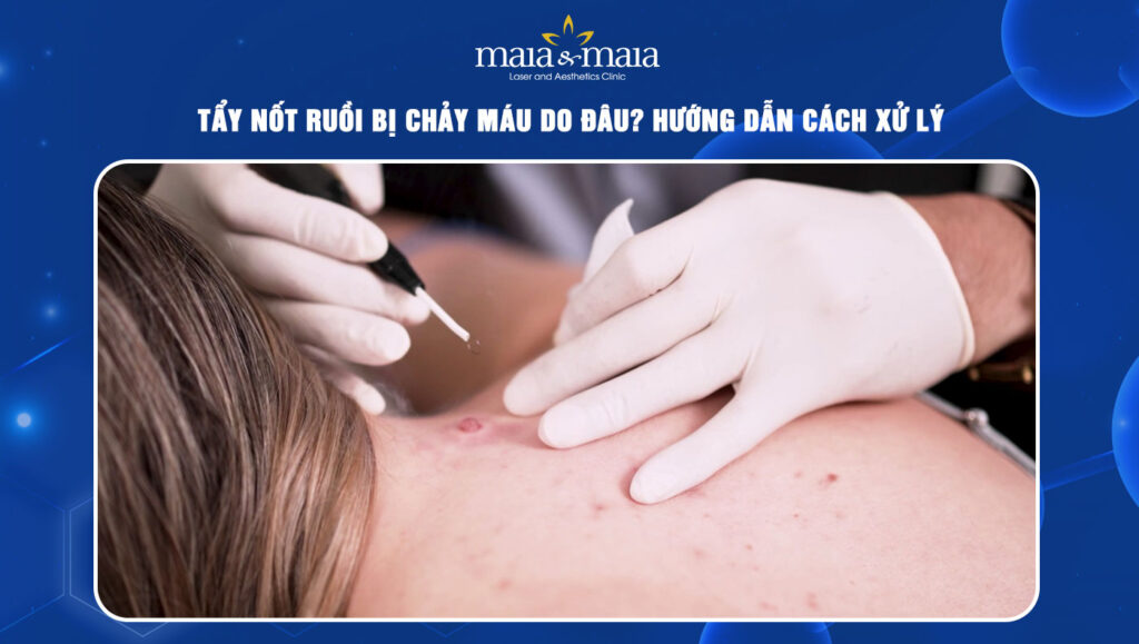 Tẩy nốt ruồi bị chảy máu