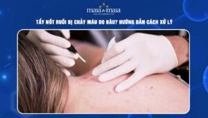 Tẩy nốt ruồi bị chảy máu