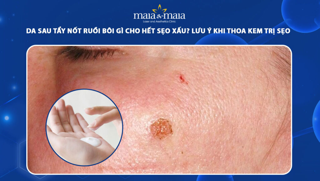 tẩy nốt ruồi bôi gì cho hết sẹo