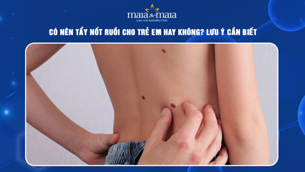 tẩy nốt ruồi cho trẻ em