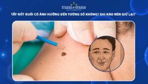 tẩy nốt ruồi có ảnh hưởng đến tướng số không